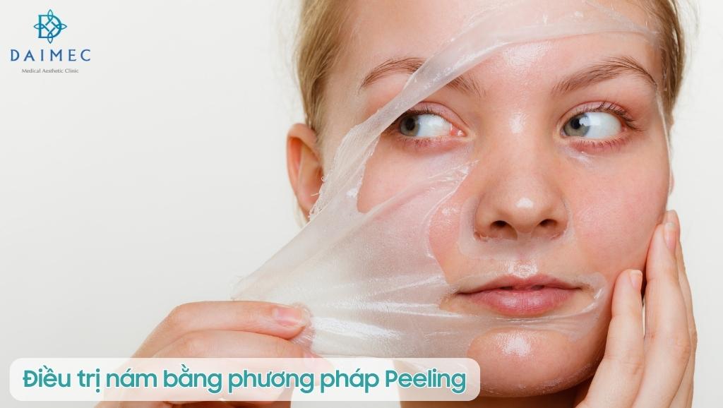 Peeling da để điều trị nám